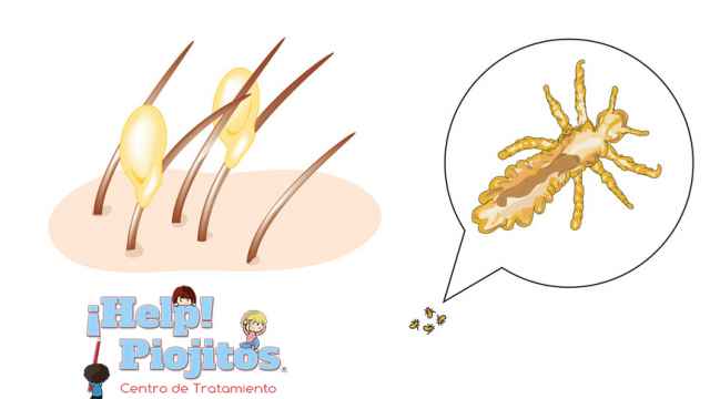 Pediculosis: Las liendres y los piojos