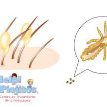 Pediculosis: Las liendres y los piojos